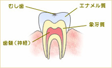 C0　初期のむし歯