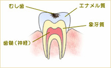 C1 エナメル質のむし歯