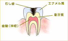 C2 象牙質のむし歯