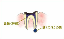C4 末期のむし歯