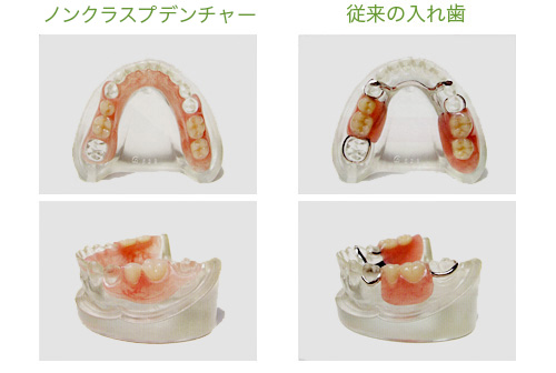 ノンクラスプデンチャー(バネの無い入れ歯)